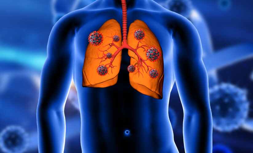 LUNG DISEASES